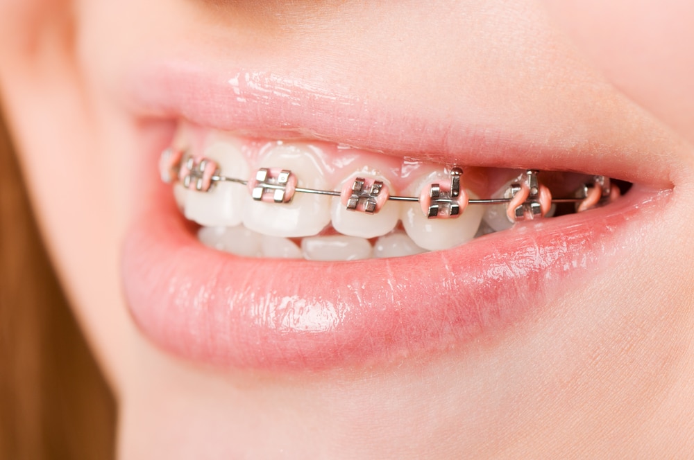 Invisalign vs Braces, Genesis Dental