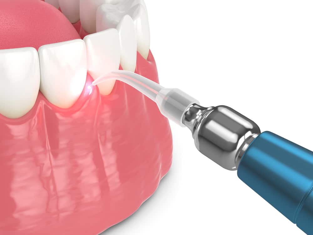 gum recontouring laser